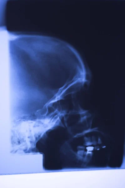 Exploración Cara Del Cráneo Los Dientes Nariz Los Ojos Radiografía — Foto de Stock