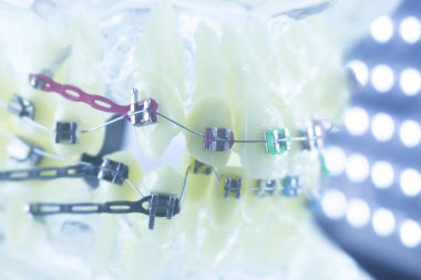 Ortodonti diş hekimleri öğretim modeli diş diş plastik ve metal köşeli parantez her diş düzleştirmek için aligners.