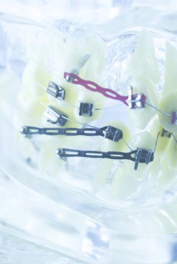 Ortodonti diş hekimleri öğretim modeli diş diş plastik ve metal köşeli parantez her diş düzleştirmek için aligners.