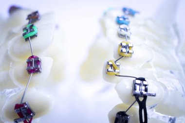 Diş metal diş teli Ortodonti modeli öğretim diş telini aligners.