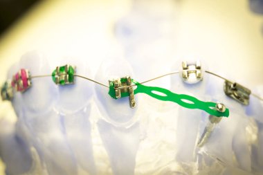 Diş metal diş teli Ortodonti modeli öğretim diş telini aligners.