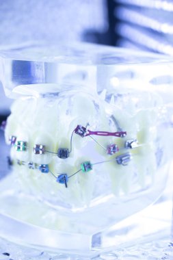 Ortodonti diş hekimleri öğretim modeli diş diş plastik ve metal köşeli parantez her diş düzleştirmek için aligners.