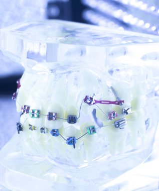 Ortodonti diş hekimleri öğretim modeli diş diş plastik ve metal köşeli parantez her diş düzleştirmek için aligners.