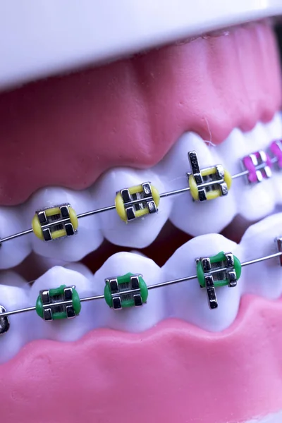 Dental Metal Aparelho Dentes Retentor Alinhadores Ensino Ortodontia Modelo — Fotografia de Stock