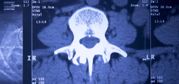 Рентген Таза Таза Позвоночника Мрт — стоковое фото