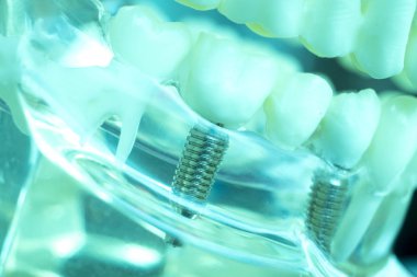 Vida diş hekimi diş diş öğretim modeli gösteren titanyum metal diş implant.