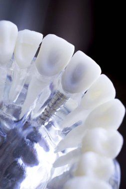 Vida diş hekimi diş diş öğretim modeli gösteren titanyum metal diş implant.