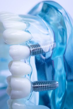 Vida diş hekimi diş diş öğretim modeli gösteren titanyum metal diş implant.