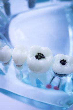 Diş hekimi diş diş modeli gösteren öğretim her diş ve dişeti hastalar ve öğrenciler için.