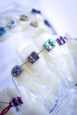 Diş metal diş teli Ortodonti modeli öğretim diş telini aligners.