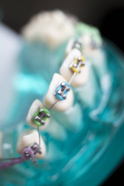 Diş metal diş teli Ortodonti modeli öğretim diş telini aligners.