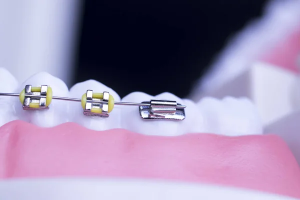 Dental Metal Aparelho Dentes Retentor Alinhadores Ensino Ortodontia Modelo — Fotografia de Stock