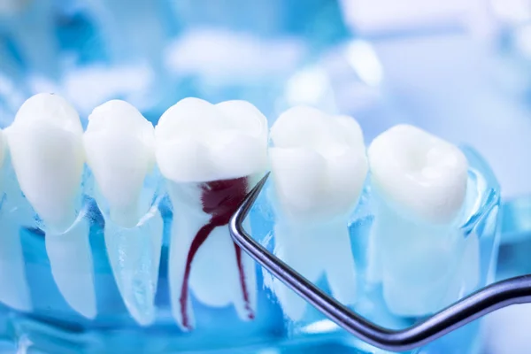 Dentiste Nettoyer Les Dents Avec Instrument Prélèvement Dents Métal Titane — Photo
