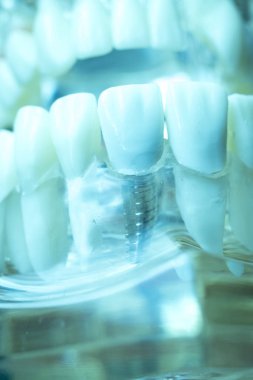 Vida diş hekimi diş diş öğretim modeli gösteren titanyum metal diş implant.