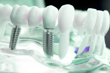 Vida diş hekimi diş diş öğretim modeli gösteren titanyum metal diş implant.