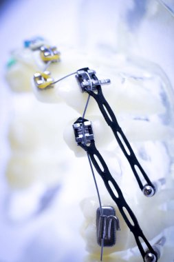 Diş metal diş teli Ortodonti modeli öğretim diş telini aligners.