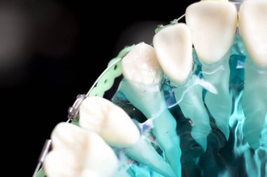 Diş metal diş teli Ortodonti modeli öğretim diş telini aligners.