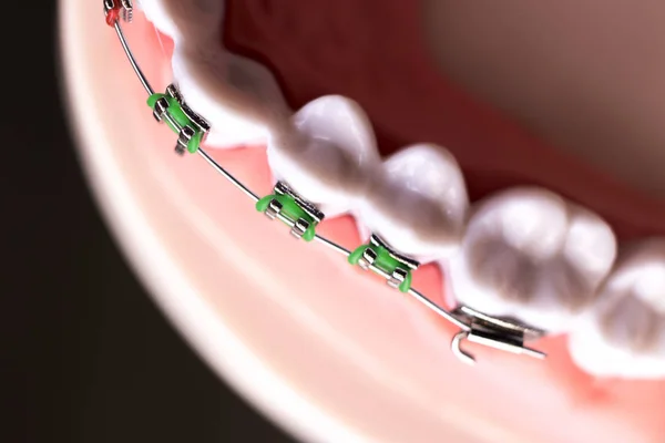 Dental Metal Aparelho Dentes Retentor Alinhadores Ensino Ortodontia Modelo — Fotografia de Stock