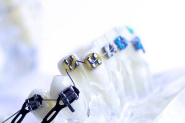 Diş metal diş teli Ortodonti modeli öğretim diş telini aligners.