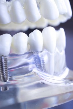 Vida diş hekimi diş diş öğretim modeli gösteren titanyum metal diş implant.