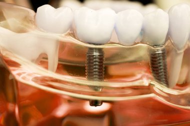 Dentist dental teeth teaching model showing titanium metal tooth implant screw. clipart