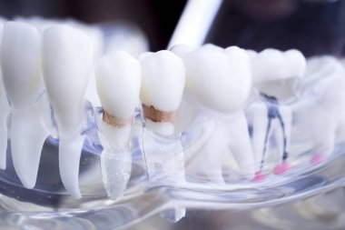 Diş hekimi diş diş modeli gösteren öğretim her diş ve dişeti hastalar ve öğrenciler için.