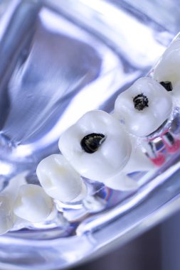 Diş hekimi diş diş modeli gösteren öğretim her diş ve dişeti hastalar ve öğrenciler için.