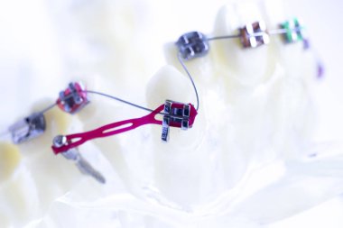 Diş metal diş teli Ortodonti modeli öğretim diş telini aligners.