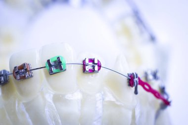 Diş metal diş teli Ortodonti modeli öğretim diş telini aligners.