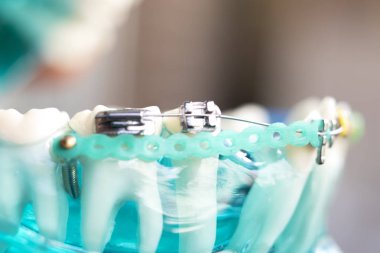 Diş metal diş teli Ortodonti modeli öğretim diş telini aligners.
