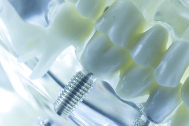 Diş titanyum estetik ortodontik diş implant diş hekimleri ağız diş modeli closeup izole.