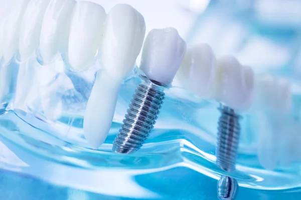 Zębów Dentystycznych Dentysta Nauczania Modelu Wyświetlone Tytanu Metalowych Zębów Implantu — Zdjęcie stockowe