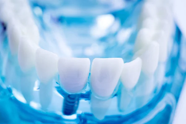 Dentist Dental Teeth Teaching Model Showing Each Tooth Gum Patients — Stock Photo, Image