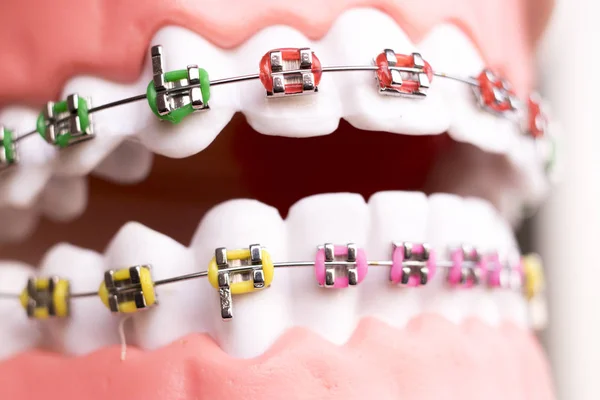 Los Apoyos Metálicos Dentales Dientes Retenedor Alineadores Enseñanza Ortodoncia Modelo —  Fotos de Stock