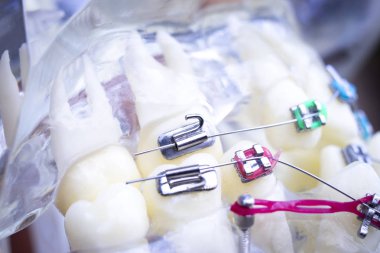 Diş metal diş teli Ortodonti modeli öğretim diş telini aligners.