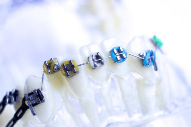 Diş metal diş teli Ortodonti modeli öğretim diş telini aligners.