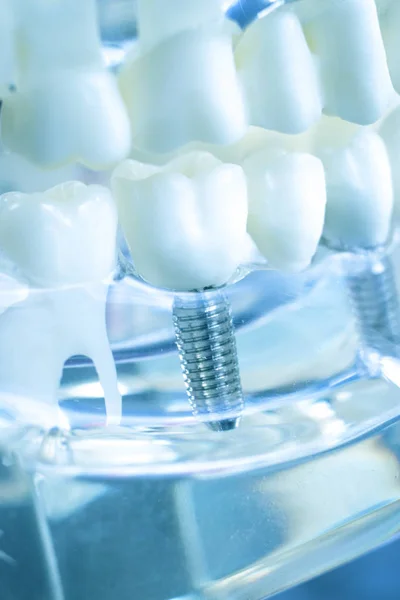 Dentista Dentale Modello Insegnamento Che Mostra Denti Titanio Metallo Vite — Foto Stock
