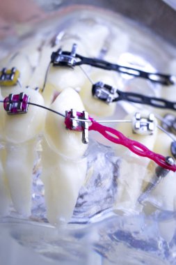 Diş metal diş teli Ortodonti modeli öğretim diş telini aligners.