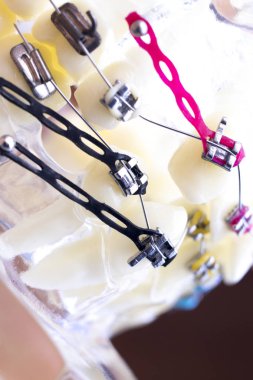 Diş metal diş teli Ortodonti modeli öğretim diş telini aligners.