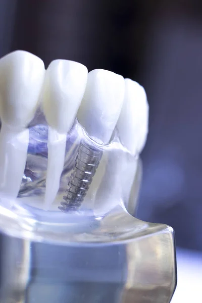 Dentista Dentale Modello Insegnamento Che Mostra Denti Titanio Metallo Vite — Foto Stock