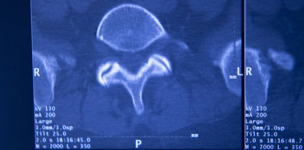 Рентген Таза Таза Позвоночника Мрт — стоковое фото