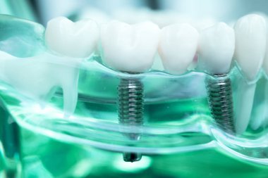 Vida diş hekimi diş diş öğretim modeli gösteren titanyum metal diş implant.