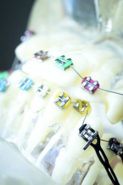 Diş metal diş teli Ortodonti modeli öğretim diş telini aligners.