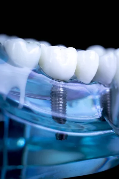 Modelo Enseñanza Dientes Dentales Dentistas Que Muestran Tornillo Implante Dientes — Foto de Stock