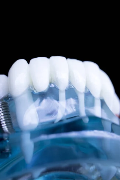 Modelo Enseñanza Dientes Dentales Dentistas Que Muestran Tornillo Implante Dientes — Foto de Stock