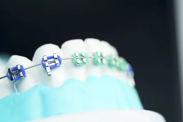Οδοντιατρική Μέταλλο Σιδερακια Δόντια Ευθυγραμμιστές Ακόλουθός Διδακτικού Μοντέλου Ορθοδοντική — Φωτογραφία Αρχείου
