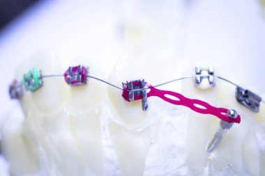 Diş metal diş teli Ortodonti modeli öğretim diş telini aligners.