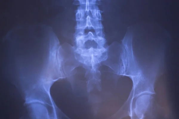 Hospital Médico Radiografía Lowe Dolor Espalda Columna Vertebral Caderas Traumatología — Foto de Stock