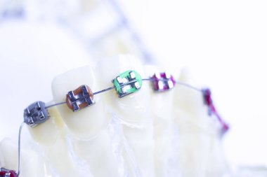 Diş metal diş teli Ortodonti modeli öğretim diş telini aligners.