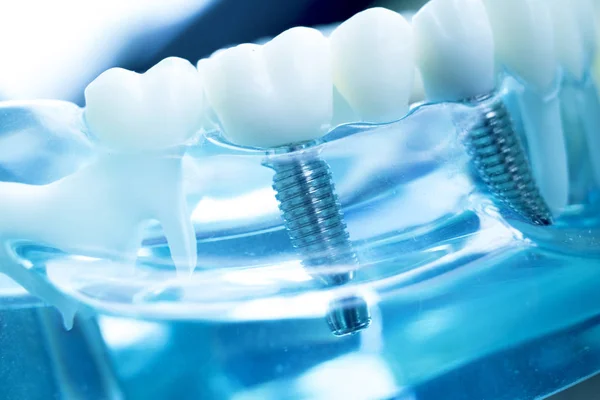 Zębów Dentystycznych Dentysta Nauczania Modelu Wyświetlone Tytanu Metalowych Zębów Implantu — Zdjęcie stockowe